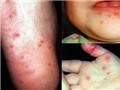 TP.HCM: Số ca mắc bệnh tay - chân - miệng giảm